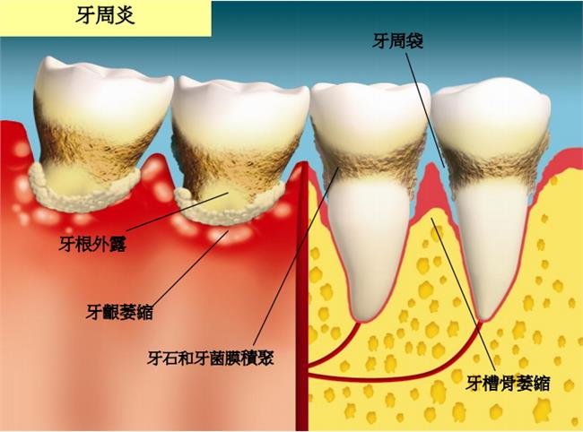 牙槽骨为什么会萎缩