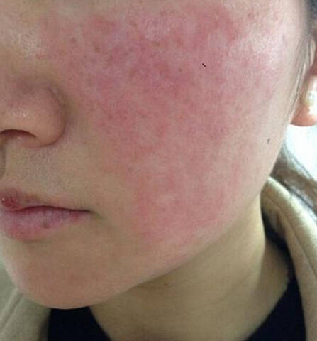 激素脸排异期间后期的症状是怎样的