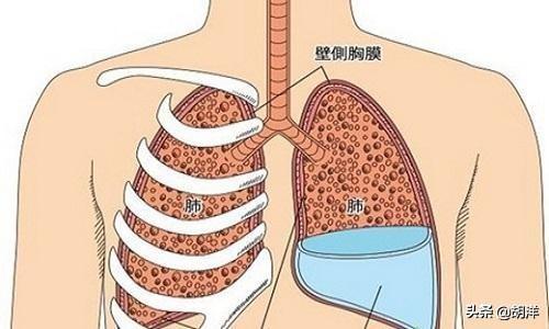 肺积水严重吗图片