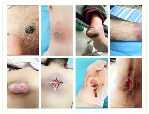 长治市中医医院创面修复科开诊啦