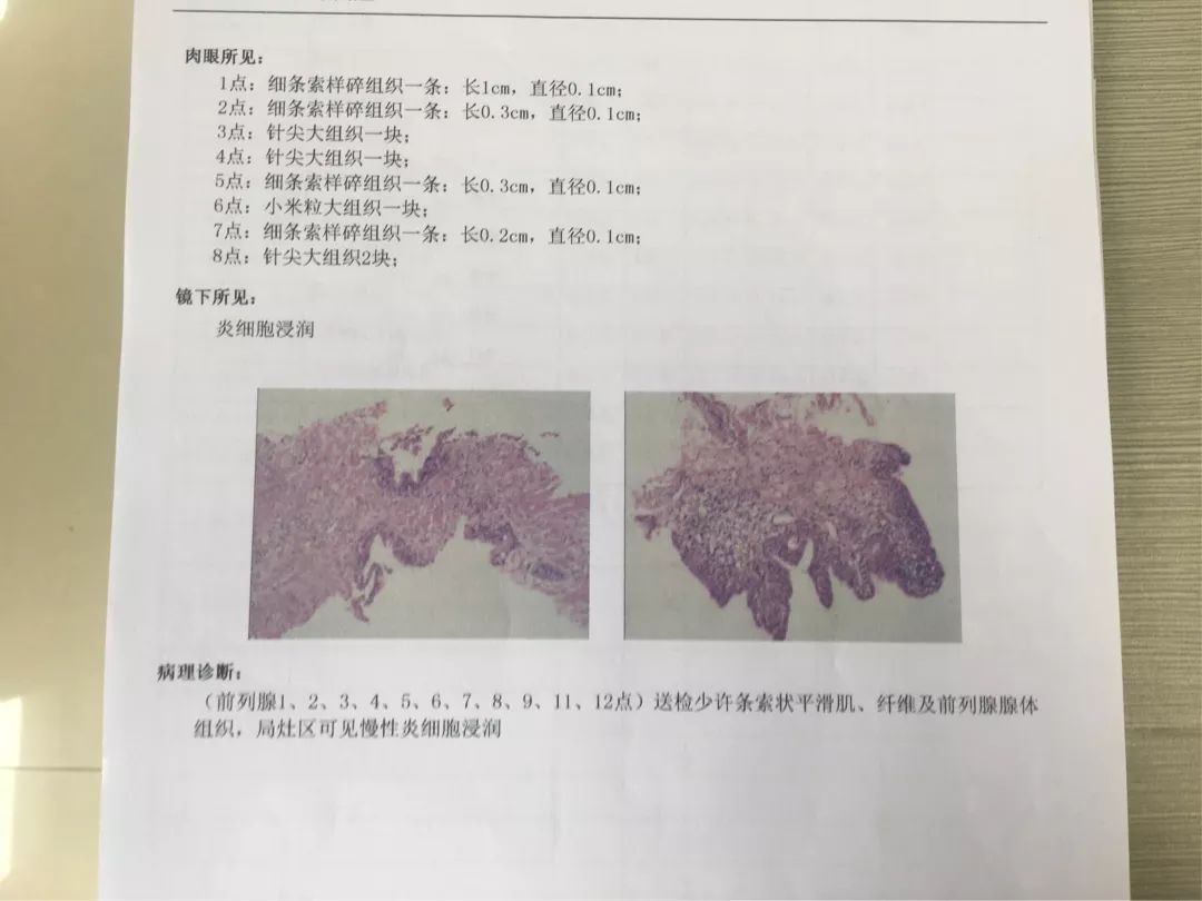前列腺穿刺活检病理学报告*那么前列腺穿刺有哪些适应症呢?