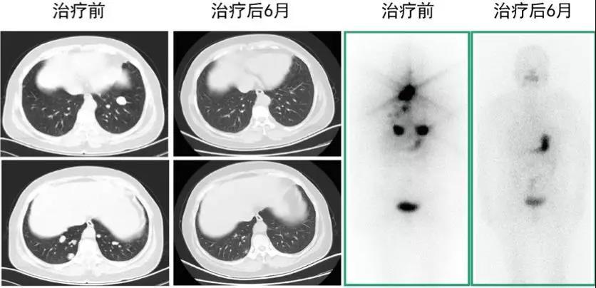 碘131全身显像正常图图片