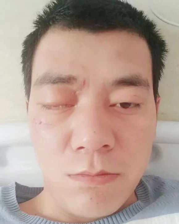 又一流动补胎人被炸,百粒碎屑溅入眼球!