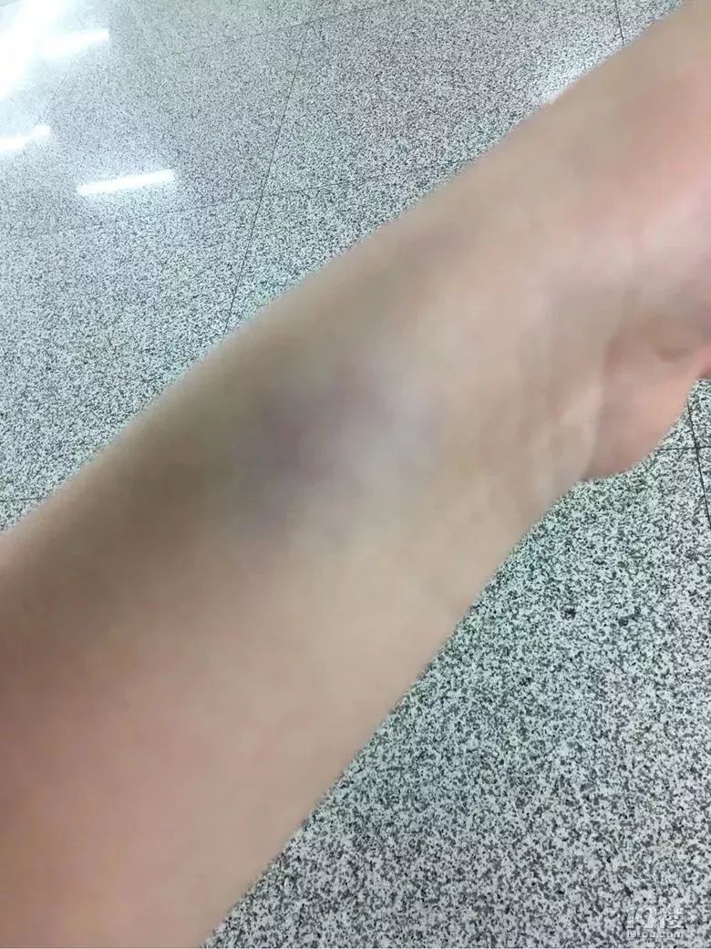 姑娘来台州当伴娘回去时浑身青紫竟是在婚礼上被