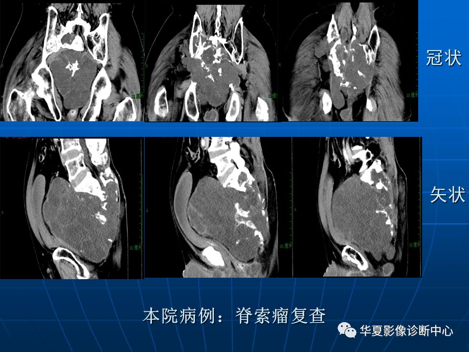 基础影像骶尾部脊索瘤影像诊断