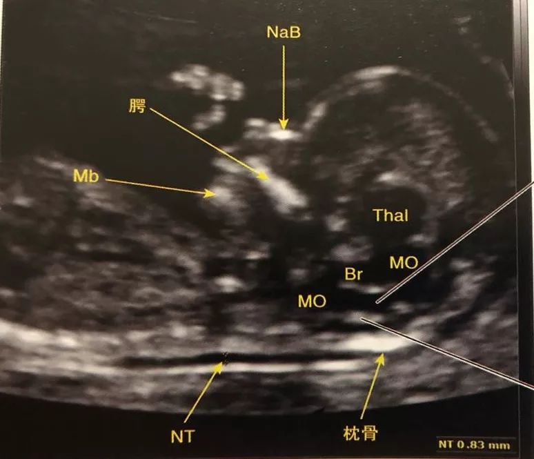 nt即胎兒頸項透明層,是指胎兒頸後皮下液體聚集的厚度.