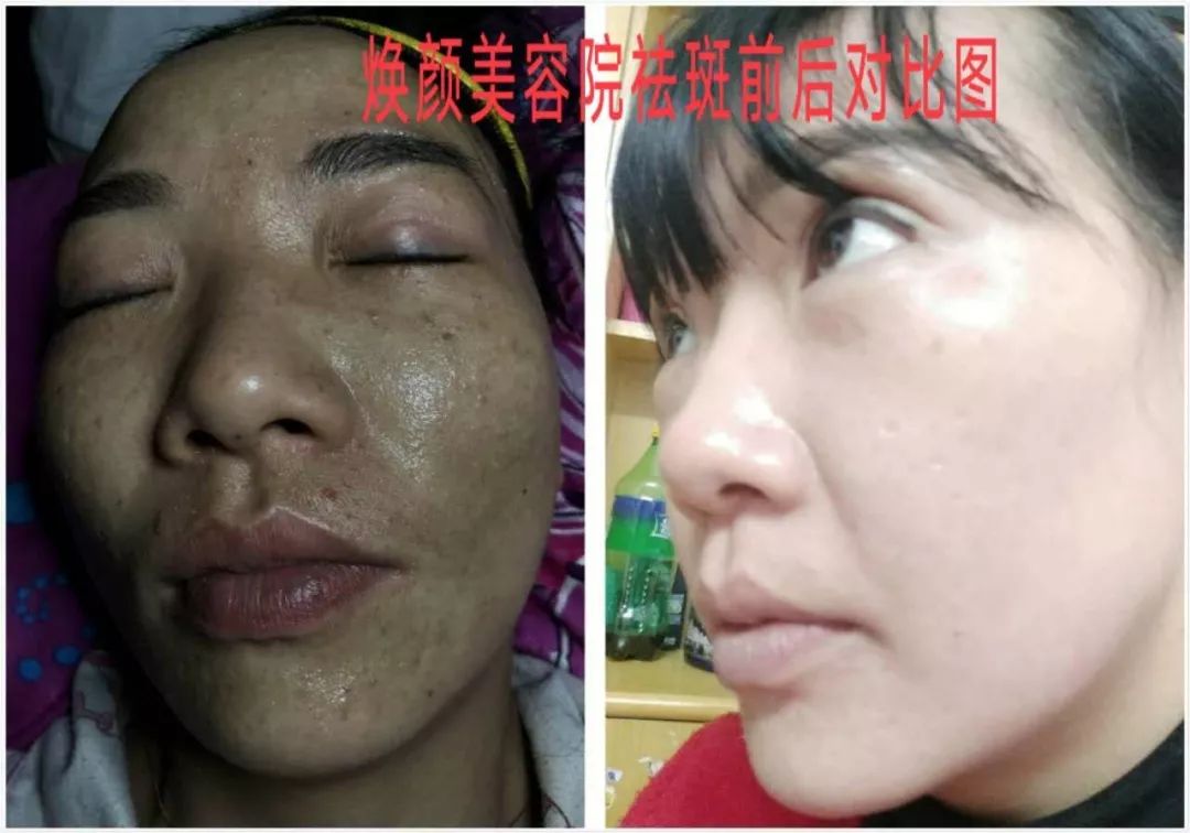 免费祛斑提取或祛痘提取1次~ 武宣超级商盟·商家推荐【焕颜美容院】