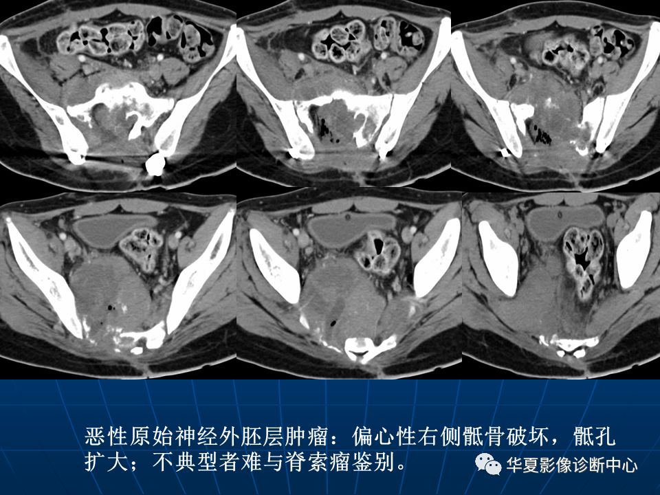 基础影像骶尾部脊索瘤影像诊断