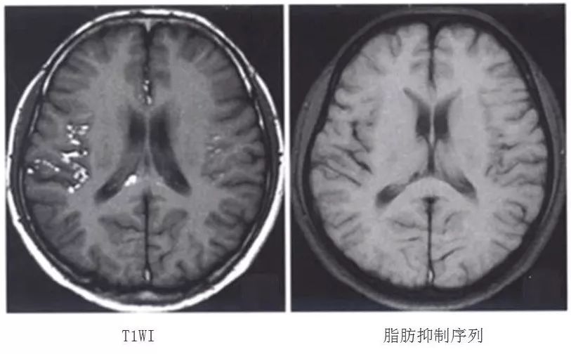 圖5 蛛網膜下腔及側腦室內脂肪滴,t1wi呈高信號,脂肪抑制序列呈低信號