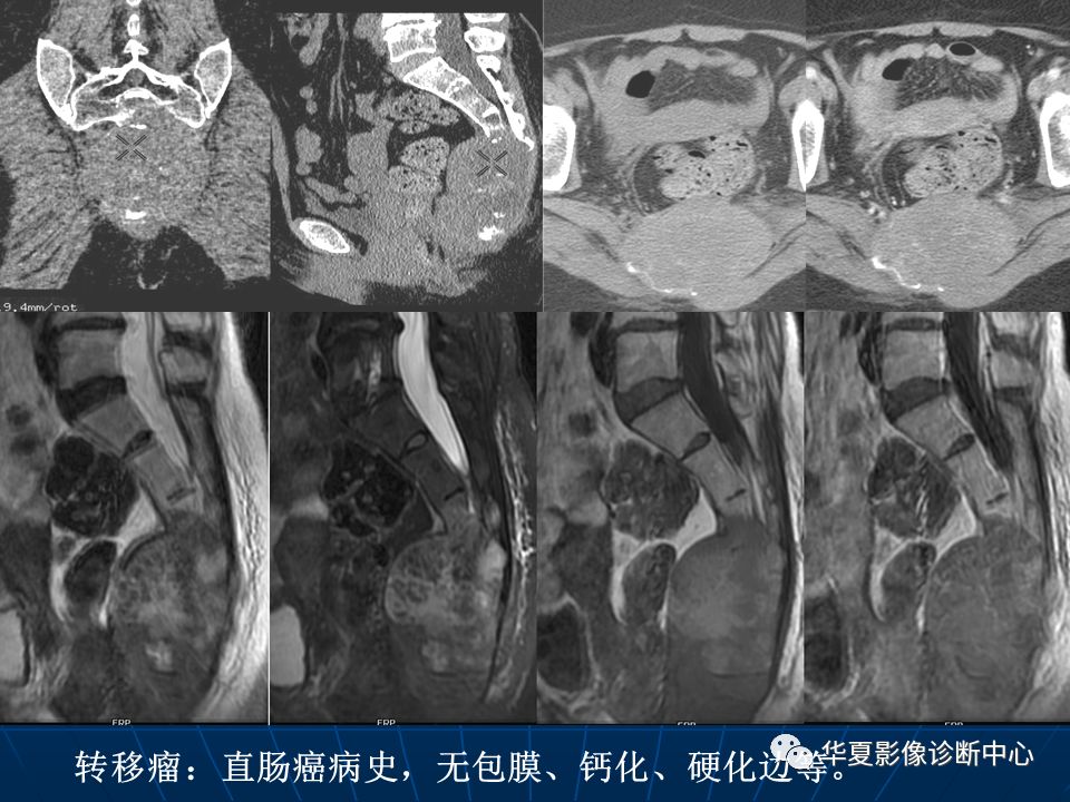 基础影像骶尾部脊索瘤影像诊断