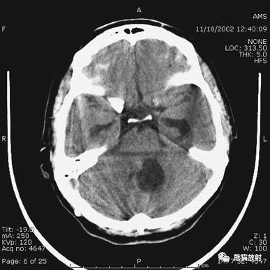 二,應注意的常見偽影本例表現:骨窗示:右頂骨骨折;三個窗均示:軟組織