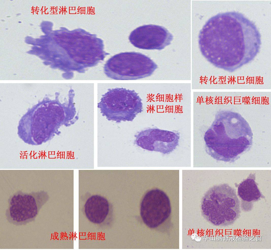 转化型淋巴细胞,可见明显的淡染区 下面一排分别为室管膜和脉络丛细胞