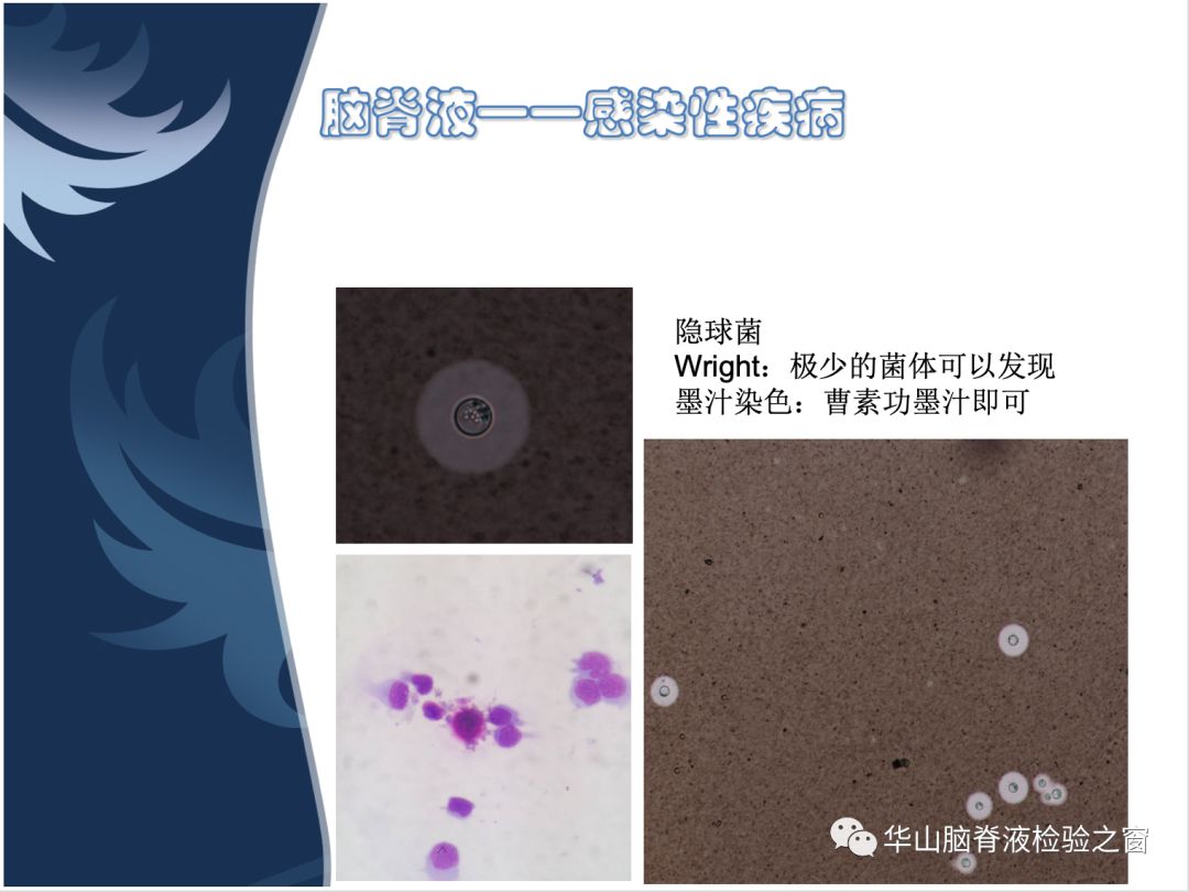 右上角可见胞内脑膜炎双球菌左下角为革兰氏染色阴性的典型脑膜炎双