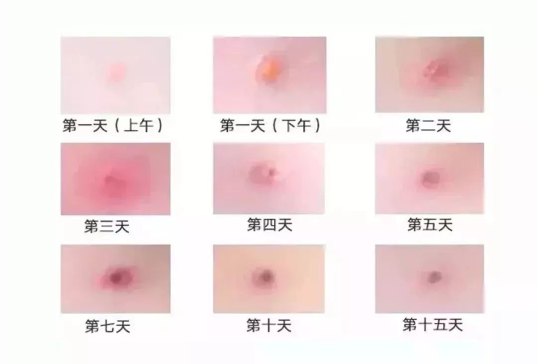 水痘变化的过程图片图片