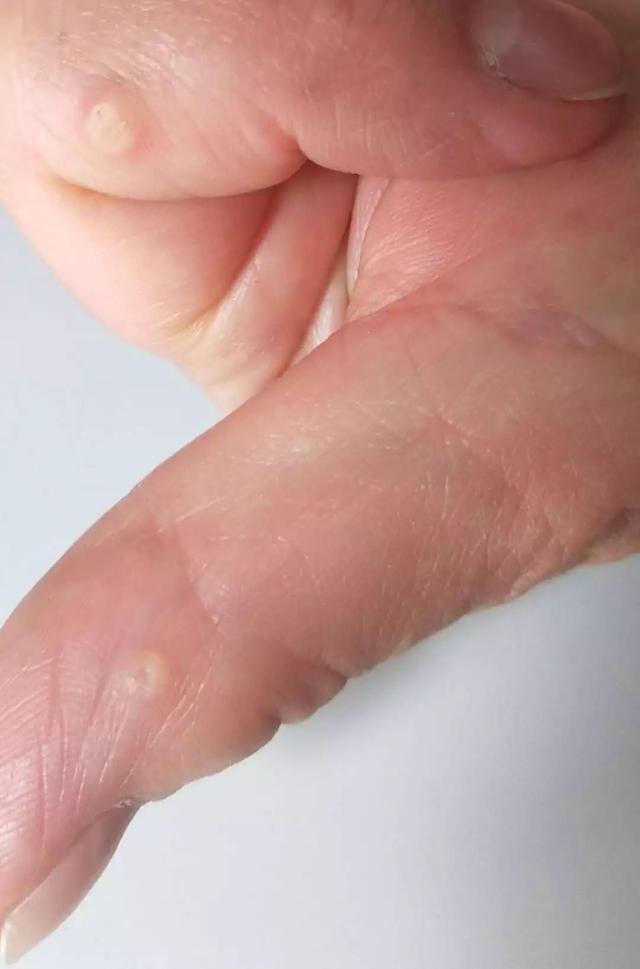 角质增生 来自搜狐网