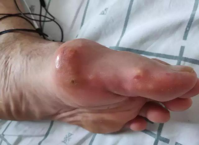 母亲节|关爱女性痛风,给母亲一份最好的节日礼物!