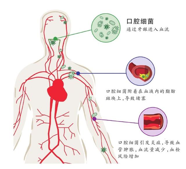 口腔炎症性疾病增加心血管事件风险国外研究"牙疼不是病,疼起来真要命