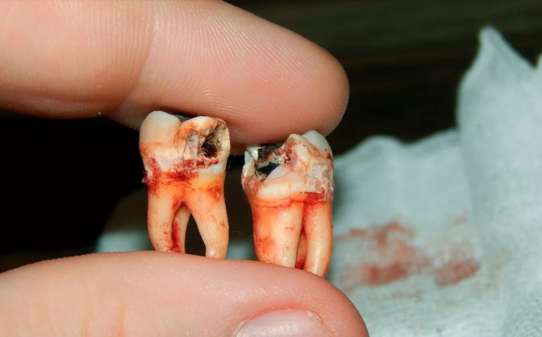 很多孕期妈妈最怕这个,痛起来比痛风还可怕!_智齿