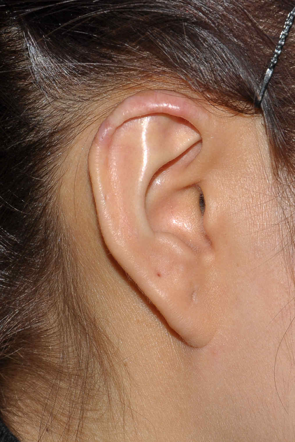 连续z成形在耳廓瘢痕疙瘩手术中的应用 (原创)_治疗