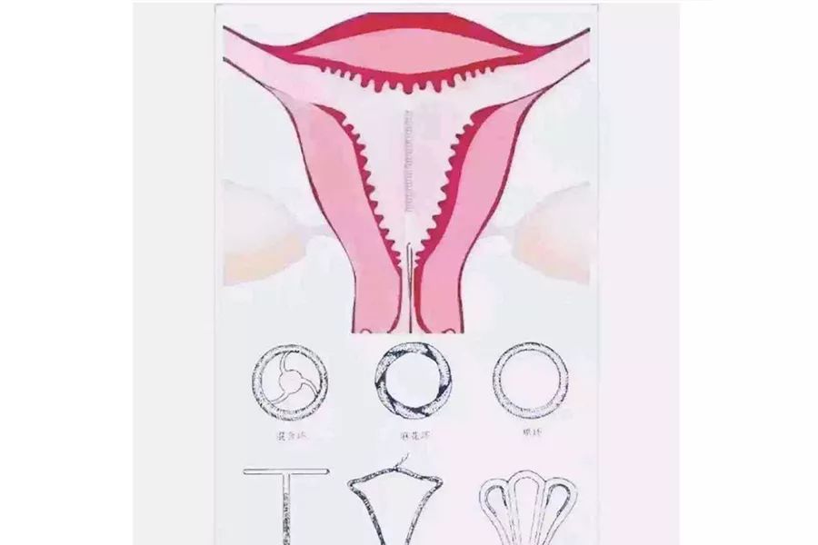 避孕环位置图片