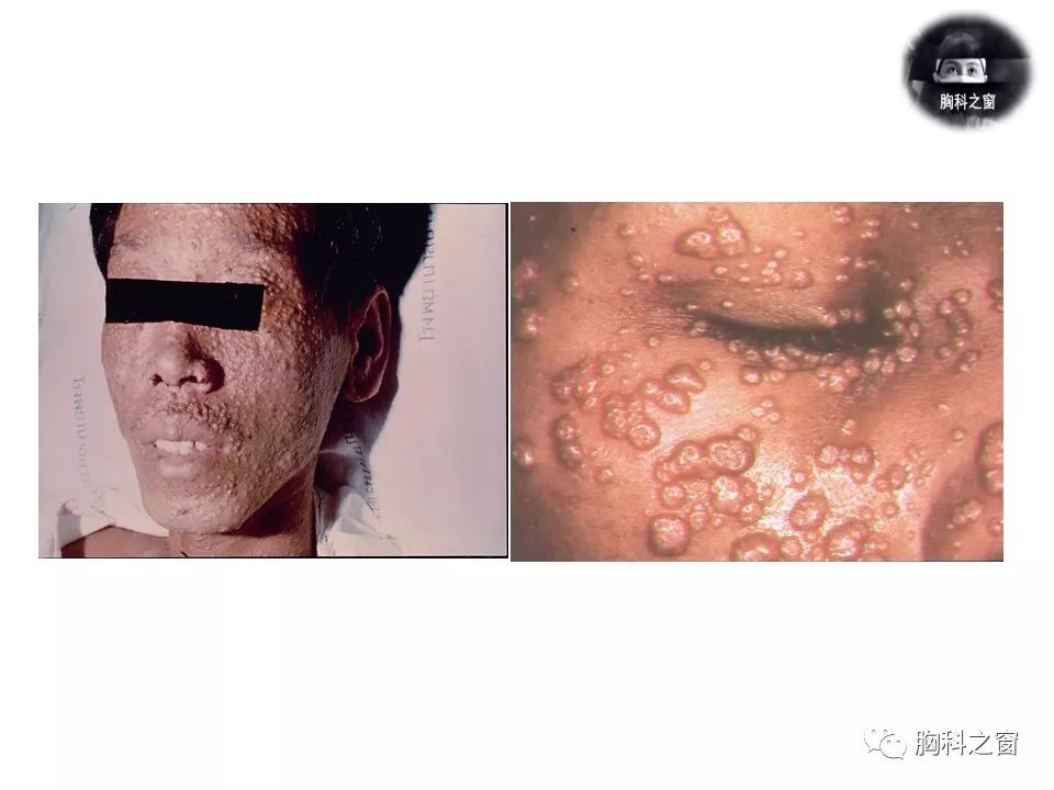马尔尼菲篮状菌肺炎图片
