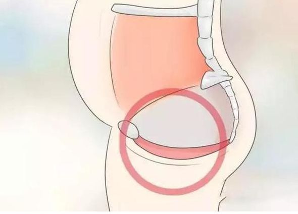 应力性尿失禁及膀胱脱垂是什么?