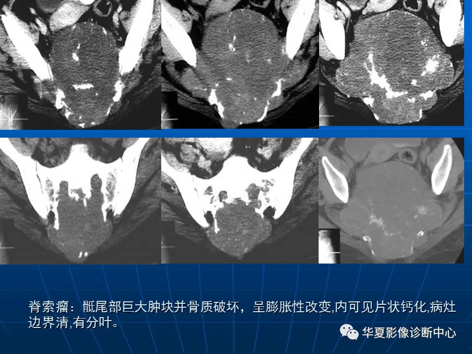 基础影像骶尾部脊索瘤影像诊断