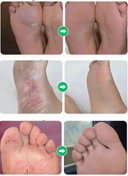 为什么脚臭要叫香港脚图片