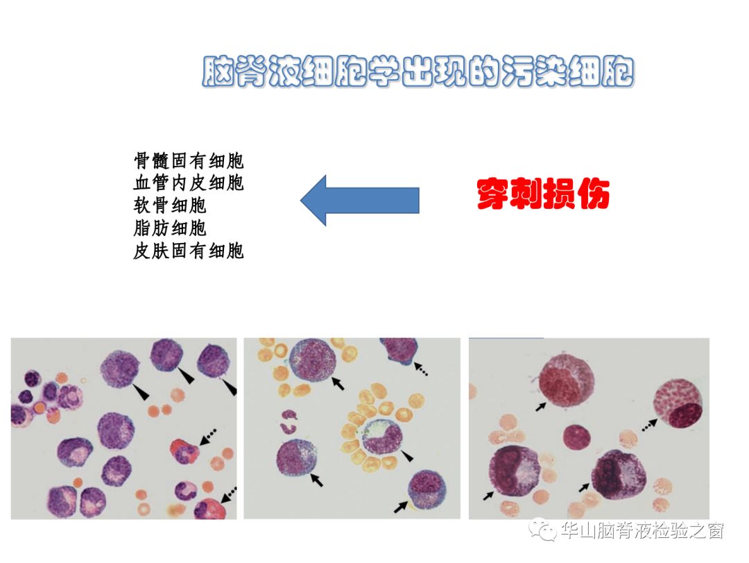 转化型淋巴细胞,可见明显的淡染区 下面一排分别为室管膜和脉络丛细胞