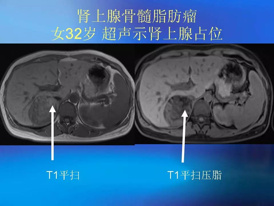 肾上腺髓质肿瘤的影像诊断及鉴别诊断影像天地
