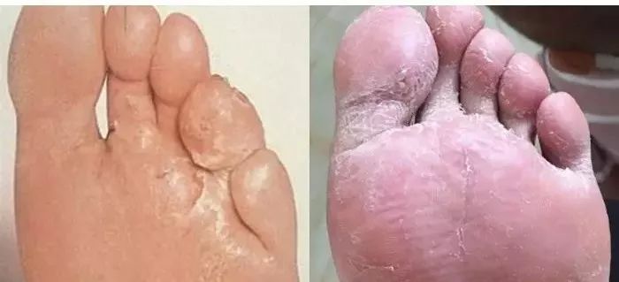 渐渐的,你脚上的皮肤开始发炎溃烂,有害物质随着脚底毛孔渗入血液