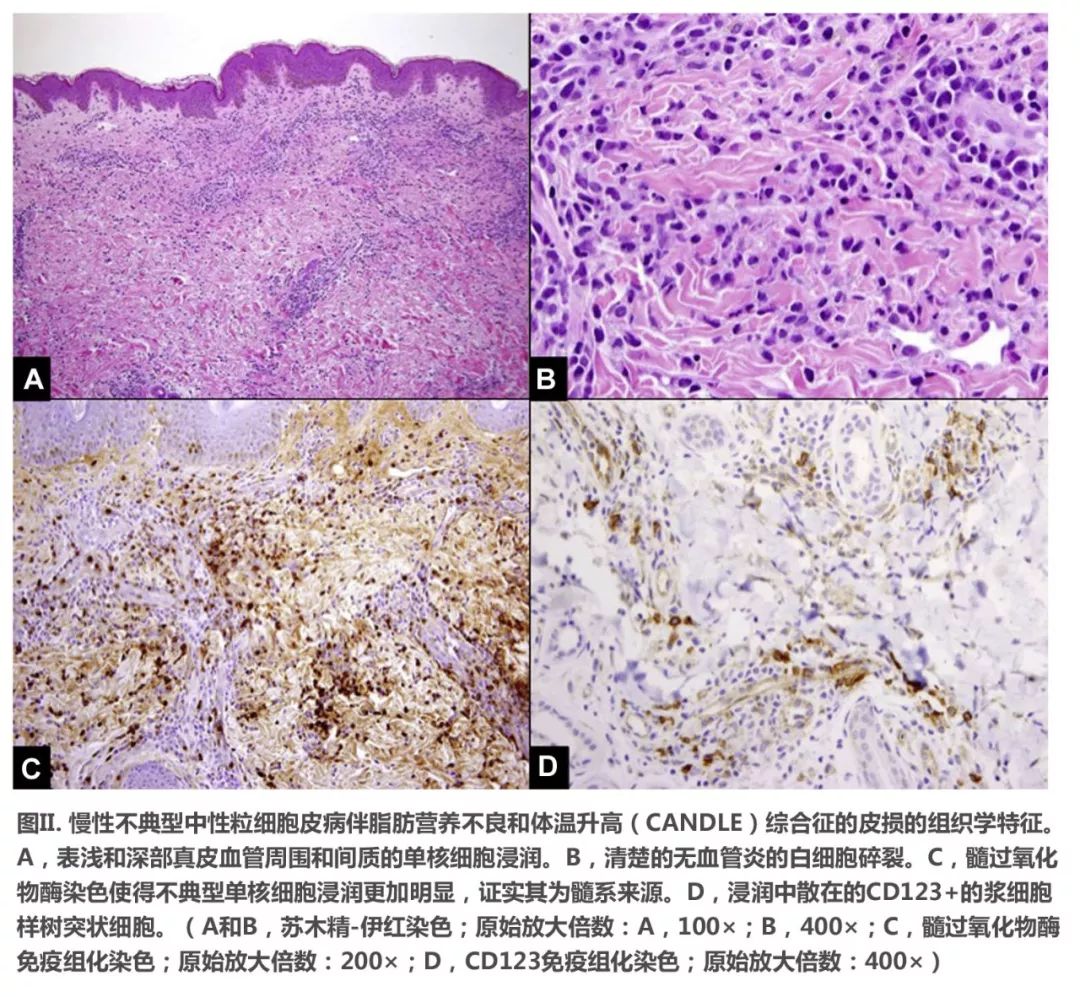 病理可見真皮間質和血管周圍以不典型單核細胞為主的浸潤,並可見白