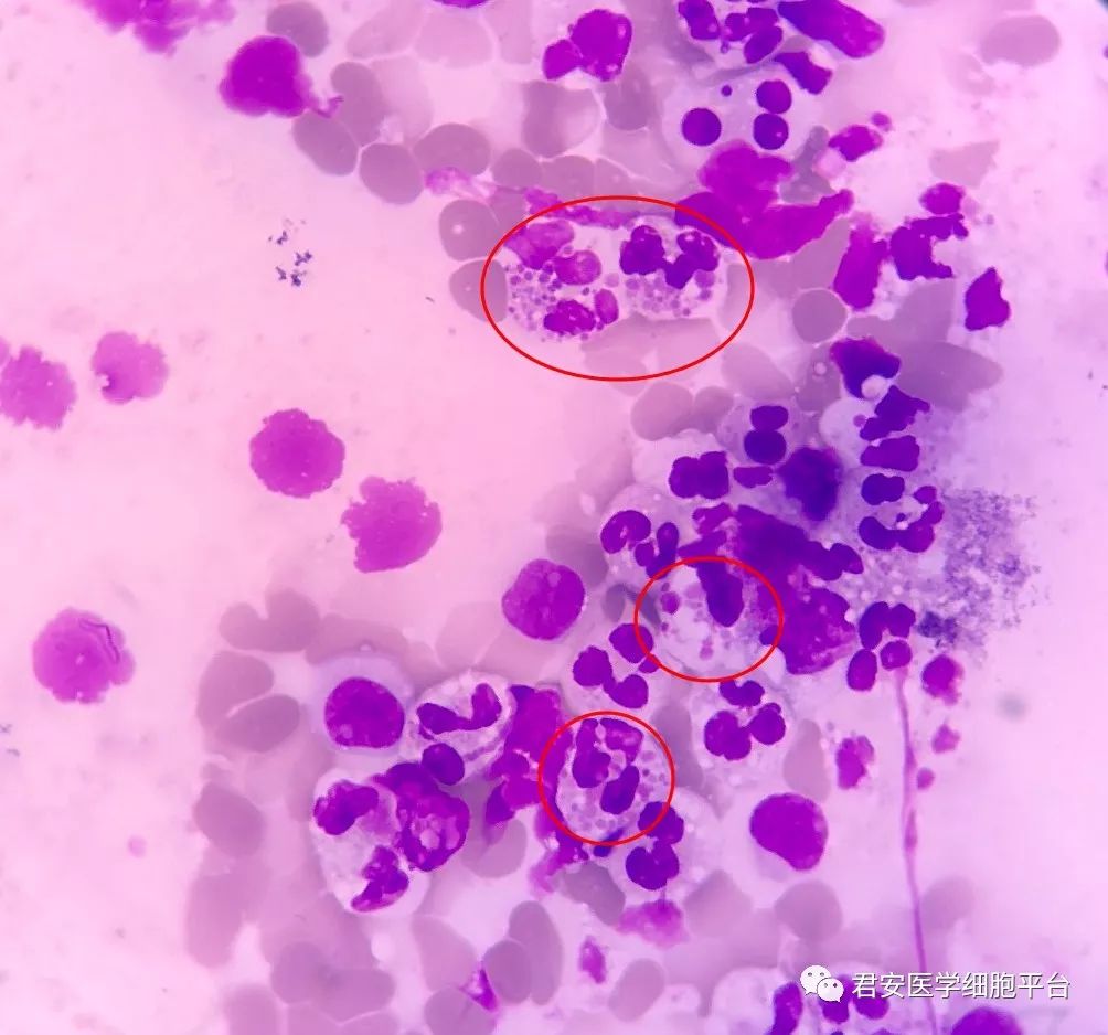 疾病知识及讨论le细胞大家常见,但是上述涂片细胞内有均匀体颗粒的并