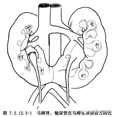 泌尿外科成功完成一例複雜性無功能馬蹄腎切除術病例