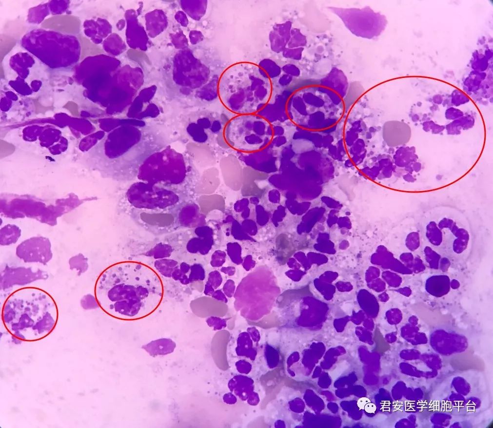 疾病知识及讨论le细胞大家常见,但是上述涂片细胞内有均匀体颗粒的并