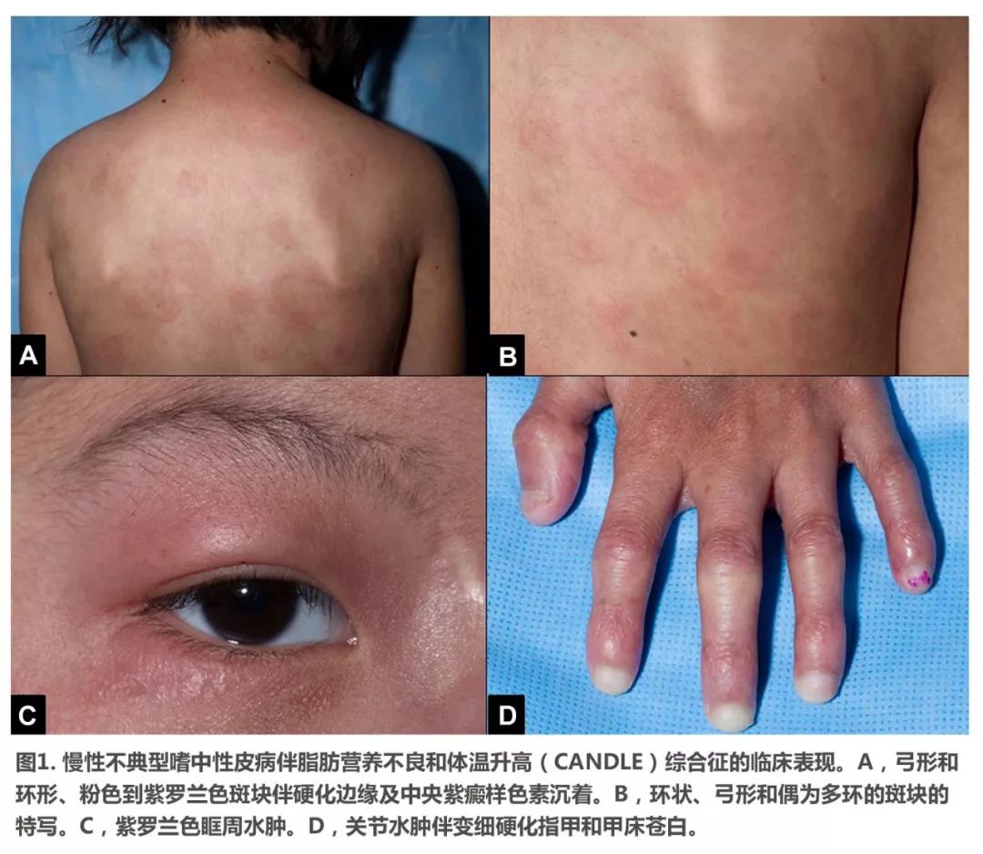 儿童反复发热进行性脂肪营养不良伴环形斑块一例