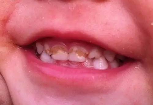 下图这种最典型,不少妈妈反应孩子的门牙缝也出现了这样的小缺口.