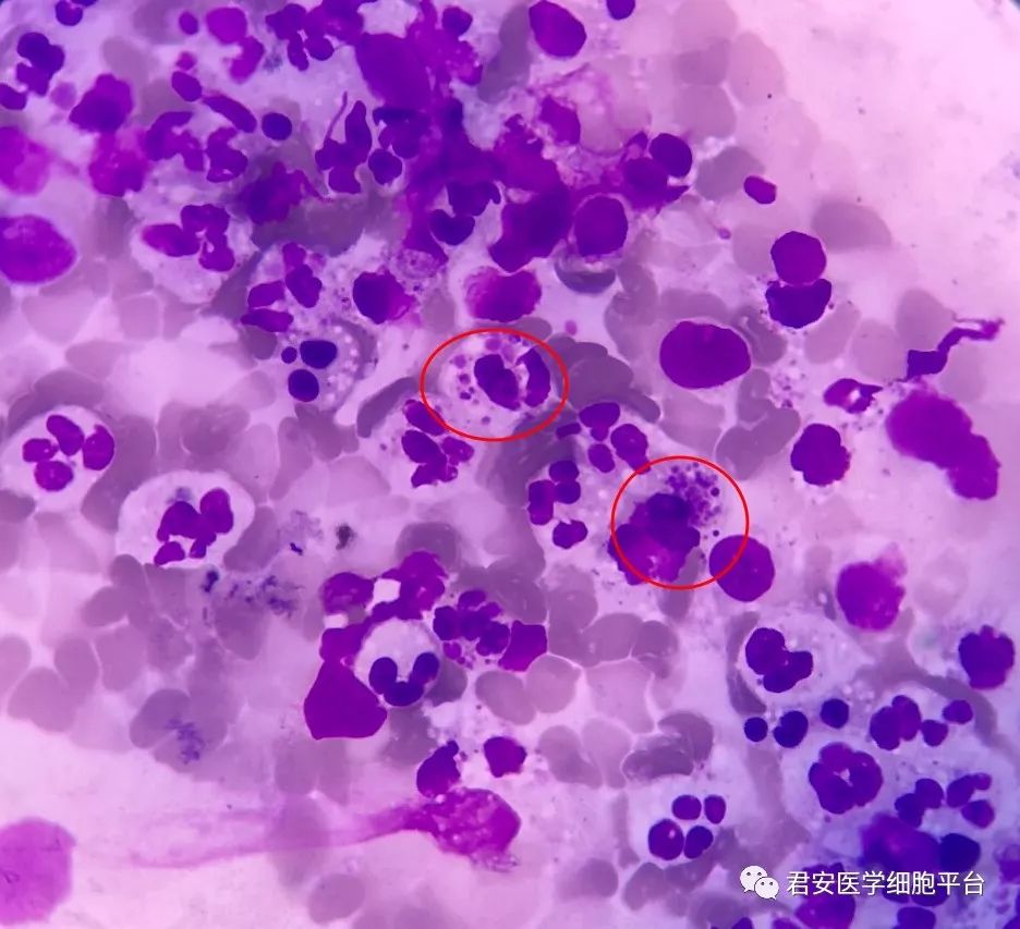 疾病知识及讨论le细胞大家常见,但是上述涂片细胞内有均匀体颗粒的并