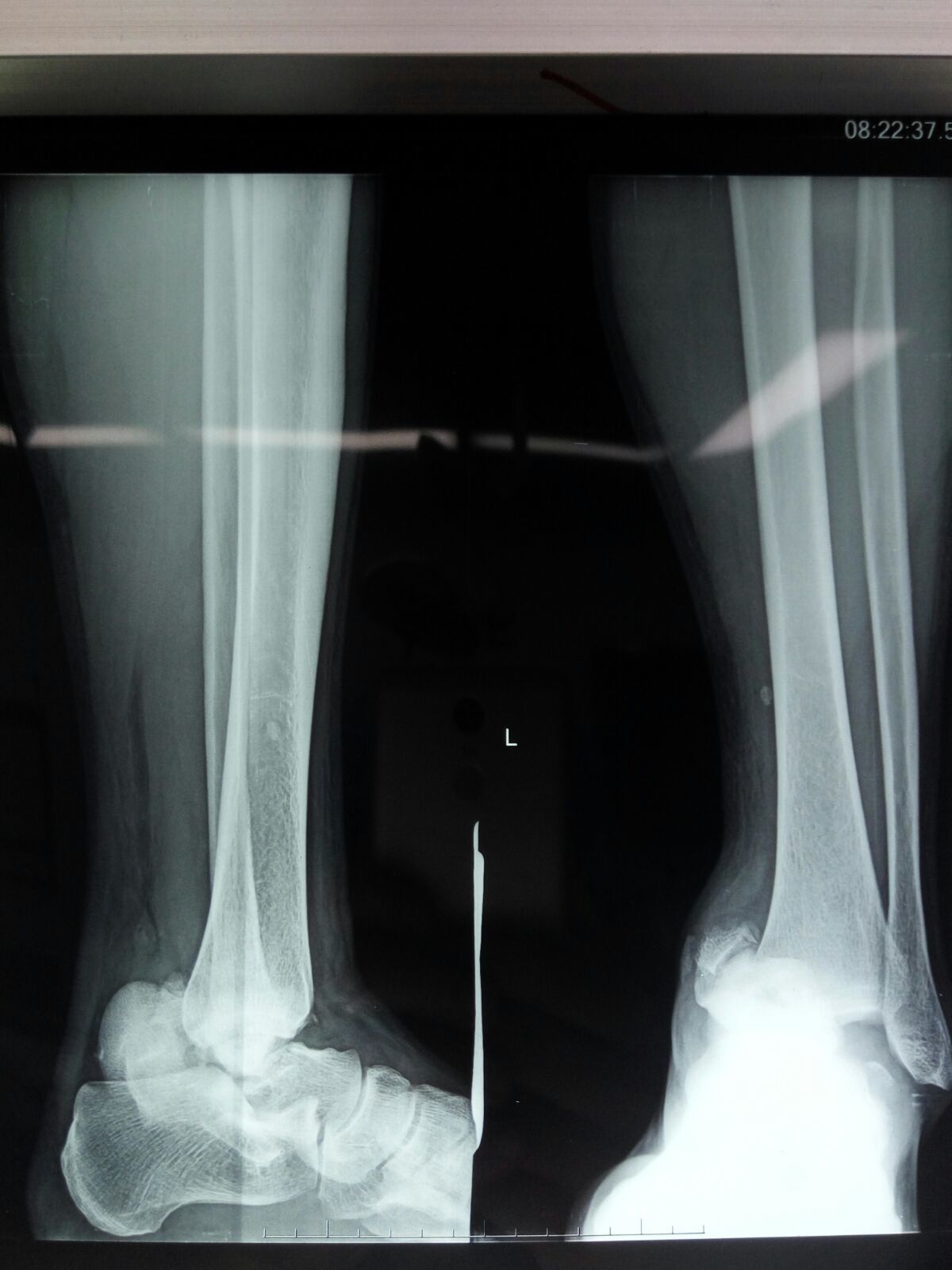 一例距骨颈骨折的治疗 (原创)_神经