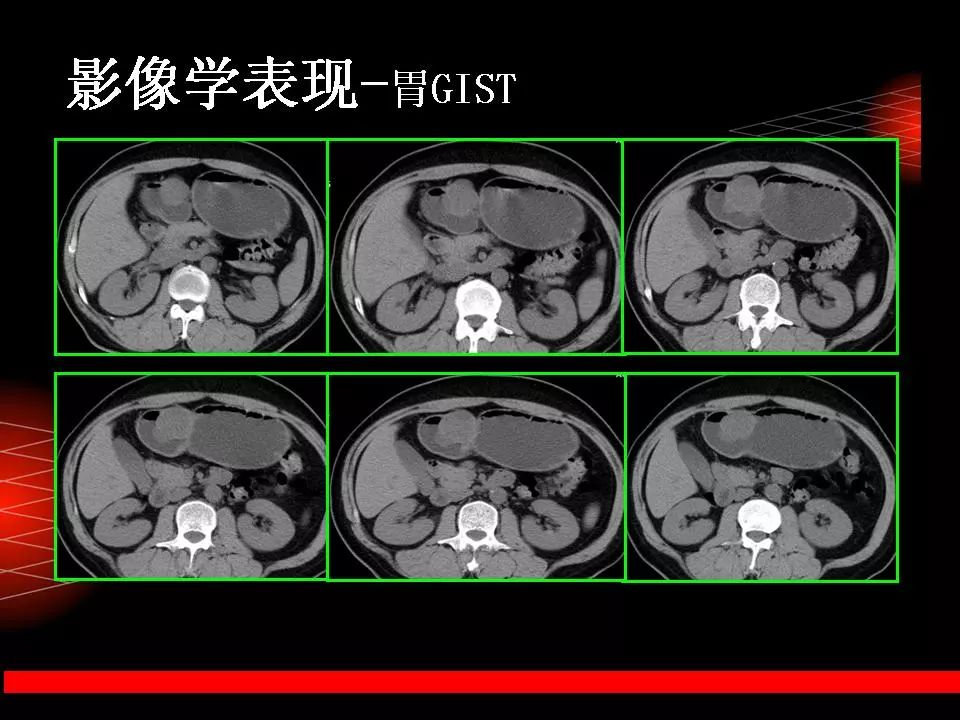 胃肠道间质瘤影像诊断与鉴别诊断 影像天地