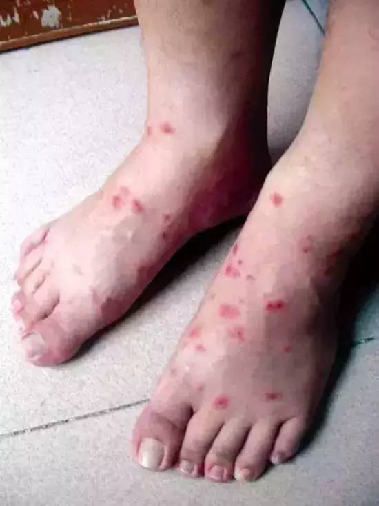 徐闻人小心农田常见的红火蚁被咬严重可导致休克