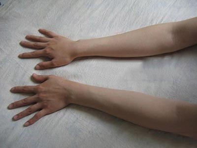 手部肌无力警惕平山病