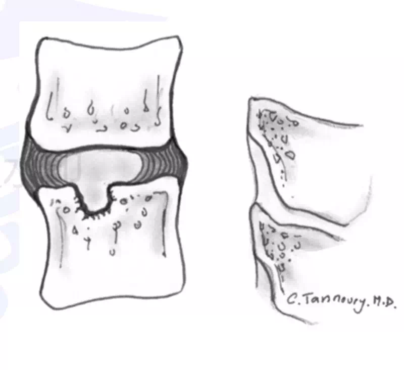 腰背痛的隐形幕后黑手症状性许莫氏结节转载