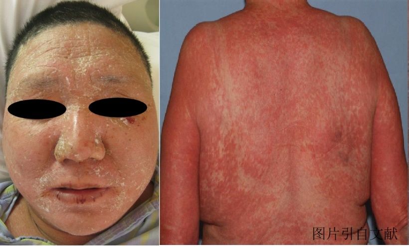 诊断,预防重症药疹,华山医院医生发现新方法