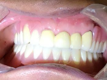 通州一老人满口松牙残根,不用拔全保住,真牙吃饭就是香!