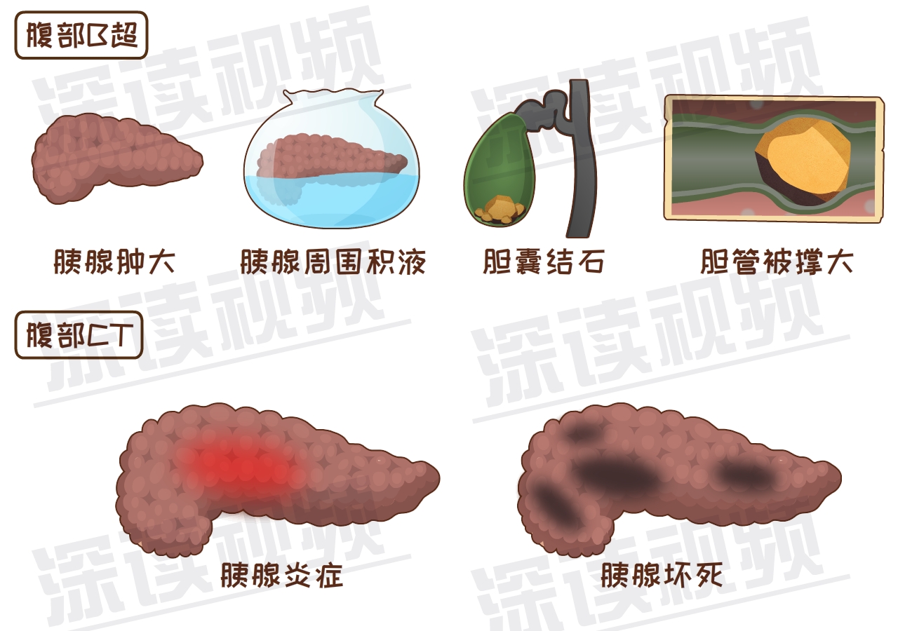 胰腺有没有炎症?是否坏死?坏死到了啥程度