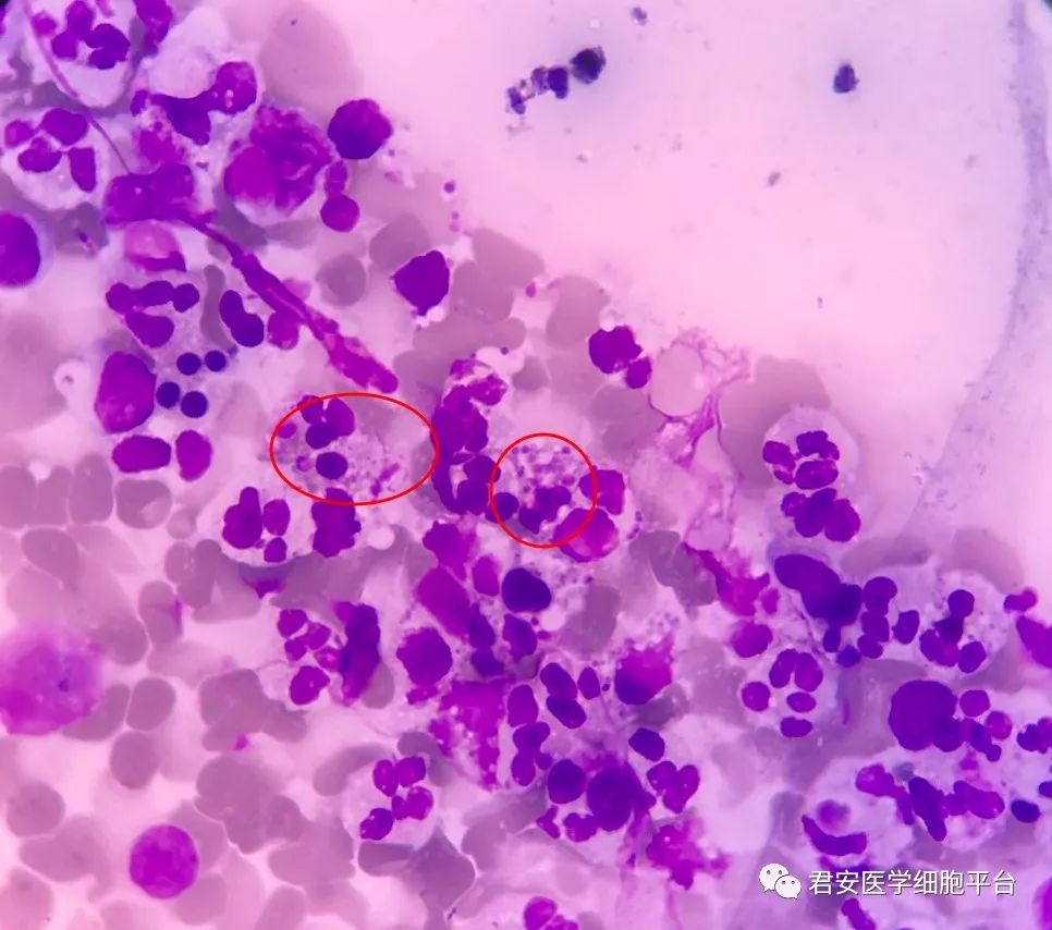 疾病知识及讨论le细胞大家常见,但是上述涂片细胞内有均匀体颗粒的并
