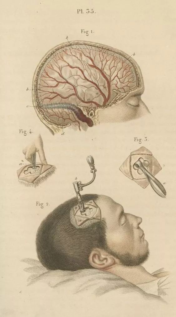 书籍中记录的开颅步骤《看见艺术家》《温迪嬷嬷讲述1000幅世界名画》