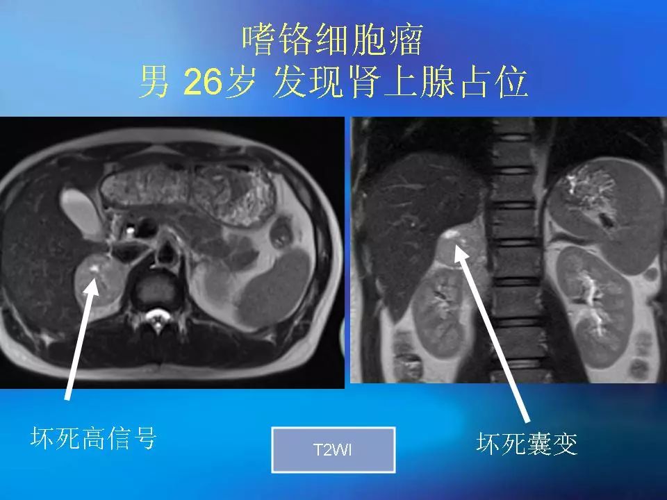 肾上腺髓质肿瘤的影像诊断及鉴别诊断影像天地