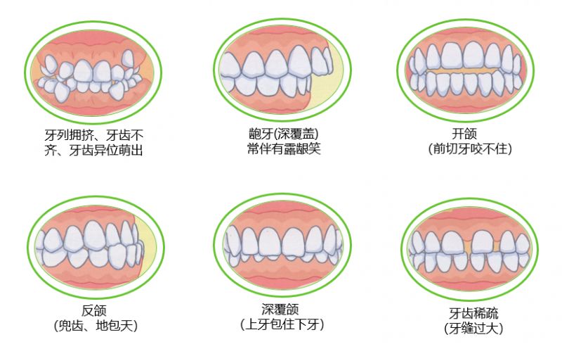 每3个孩子就有2个牙齿不齐你的孩子中招了吗